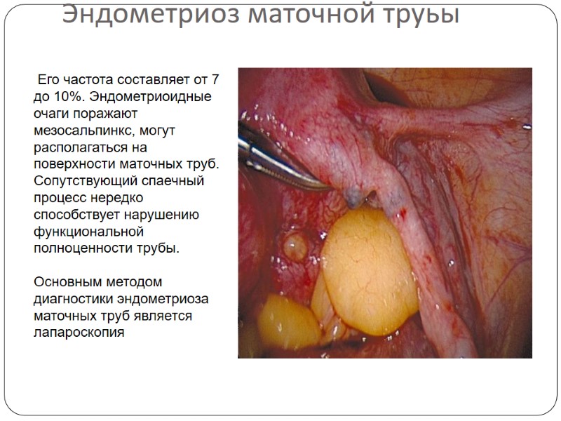 Эндометриоз маточной труьы  Его частота составляет от 7 до 10%. Эндометриоидные очаги поражают